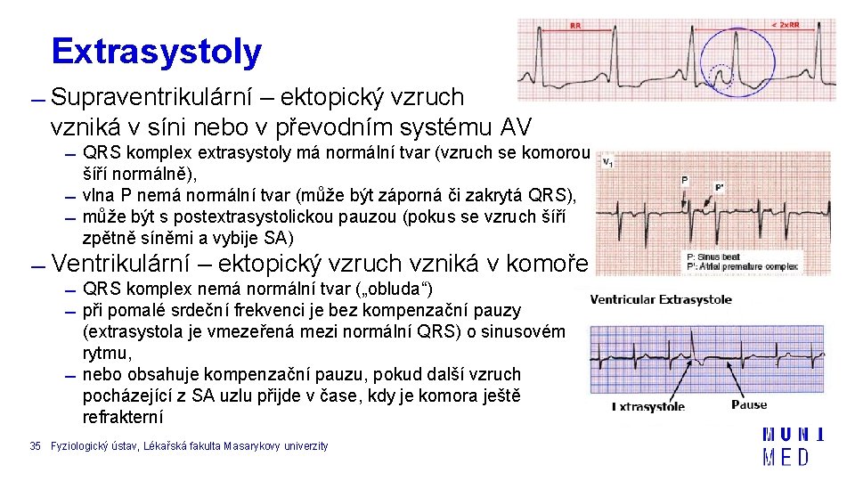 Extrasystoly Supraventrikulární – ektopický vzruch vzniká v síni nebo v převodním systému AV QRS