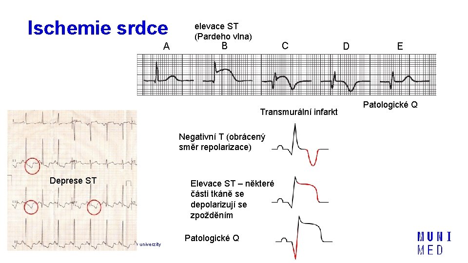 Ischemie srdce A elevace ST (Pardeho vlna) B C Transmurální infarkt Negativní T (obrácený