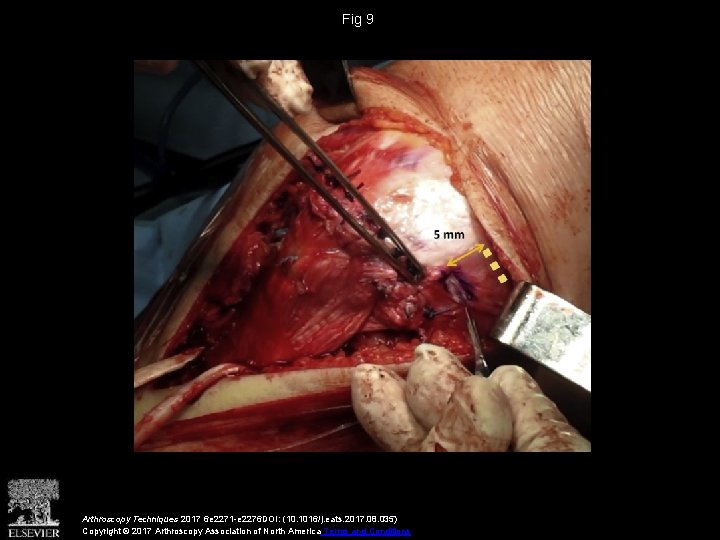 Fig 9 Arthroscopy Techniques 2017 6 e 2271 -e 2276 DOI: (10. 1016/j. eats.