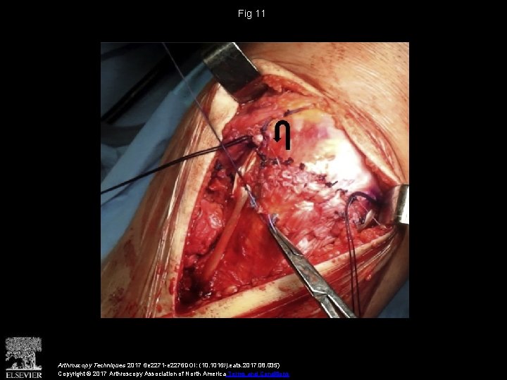 Fig 11 Arthroscopy Techniques 2017 6 e 2271 -e 2276 DOI: (10. 1016/j. eats.