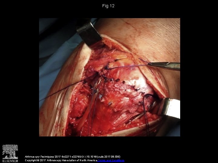 Fig 12 Arthroscopy Techniques 2017 6 e 2271 -e 2276 DOI: (10. 1016/j. eats.