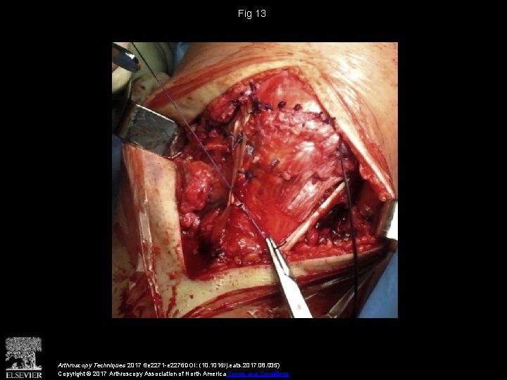 Fig 13 Arthroscopy Techniques 2017 6 e 2271 -e 2276 DOI: (10. 1016/j. eats.