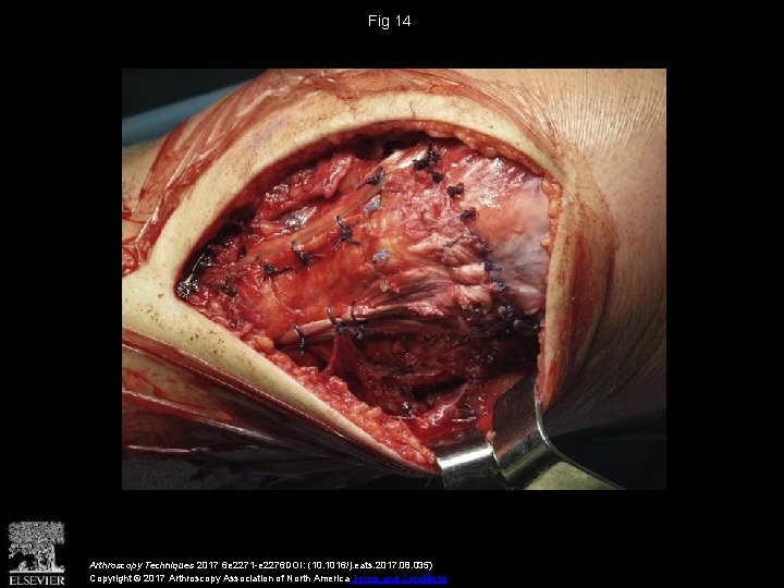 Fig 14 Arthroscopy Techniques 2017 6 e 2271 -e 2276 DOI: (10. 1016/j. eats.