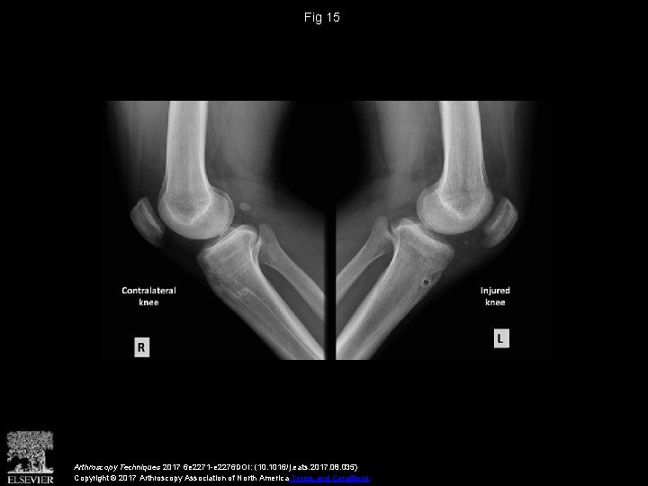 Fig 15 Arthroscopy Techniques 2017 6 e 2271 -e 2276 DOI: (10. 1016/j. eats.
