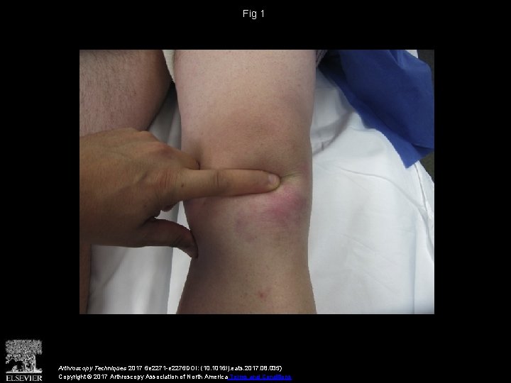 Fig 1 Arthroscopy Techniques 2017 6 e 2271 -e 2276 DOI: (10. 1016/j. eats.