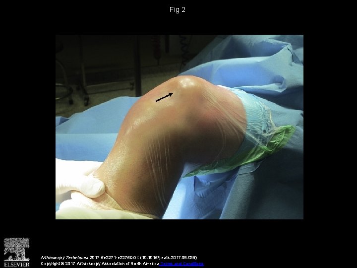Fig 2 Arthroscopy Techniques 2017 6 e 2271 -e 2276 DOI: (10. 1016/j. eats.