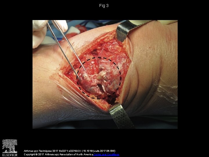Fig 3 Arthroscopy Techniques 2017 6 e 2271 -e 2276 DOI: (10. 1016/j. eats.