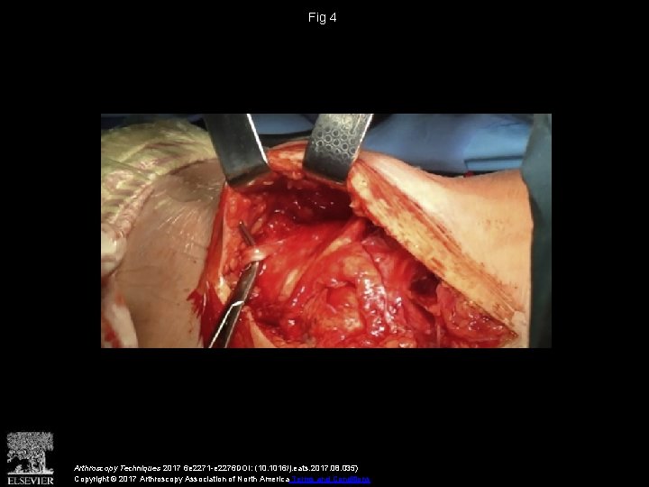 Fig 4 Arthroscopy Techniques 2017 6 e 2271 -e 2276 DOI: (10. 1016/j. eats.