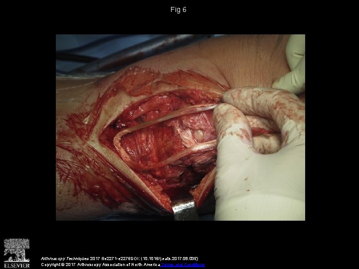 Fig 6 Arthroscopy Techniques 2017 6 e 2271 -e 2276 DOI: (10. 1016/j. eats.