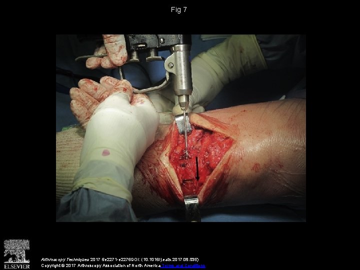 Fig 7 Arthroscopy Techniques 2017 6 e 2271 -e 2276 DOI: (10. 1016/j. eats.