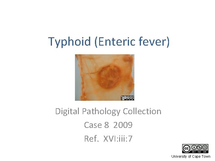 Typhoid (Enteric fever) Digital Pathology Collection Case 8 2009 Ref. XVI: iii: 7 University