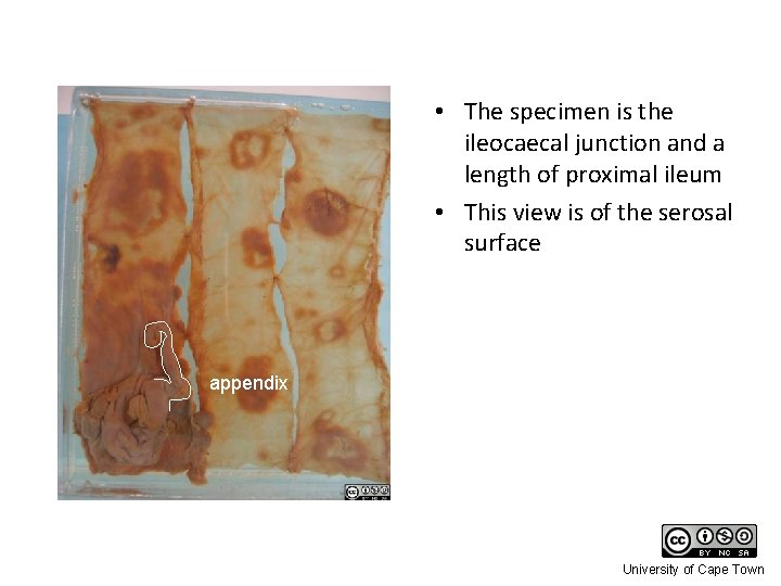  • The specimen is the ileocaecal junction and a length of proximal ileum