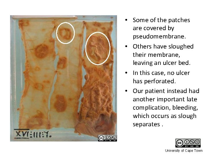  • Some of the patches are covered by pseudomembrane. • Others have sloughed