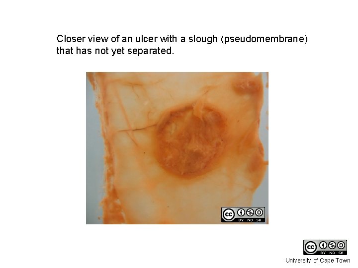 Closer view of an ulcer with a slough (pseudomembrane) that has not yet separated.