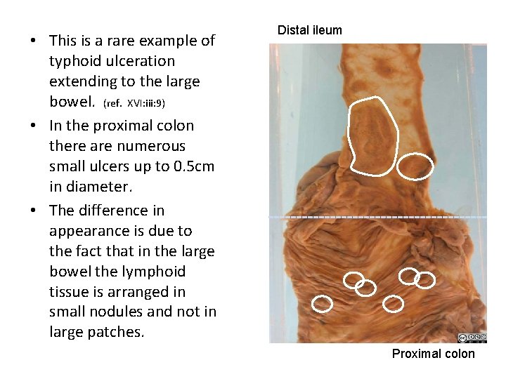  • This is a rare example of typhoid ulceration extending to the large