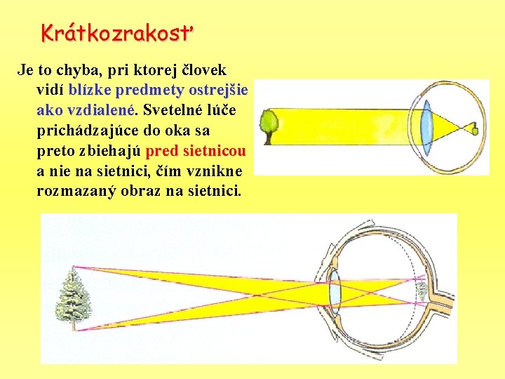 Krátkozrakosť Je to chyba, pri ktorej človek vidí blízke predmety ostrejšie ako vzdialené Svetelné