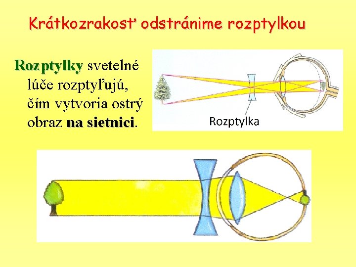 Krátkozrakosť odstránime rozptylkou Rozptylky svetelné lúče rozptyľujú, čím vytvoria ostrý obraz na sietnici 