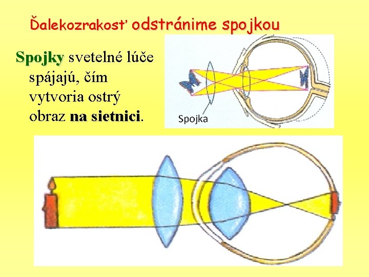 Ďalekozrakosť odstránime spojkou Spojky svetelné lúče spájajú, čím vytvoria ostrý obraz na sietnici 