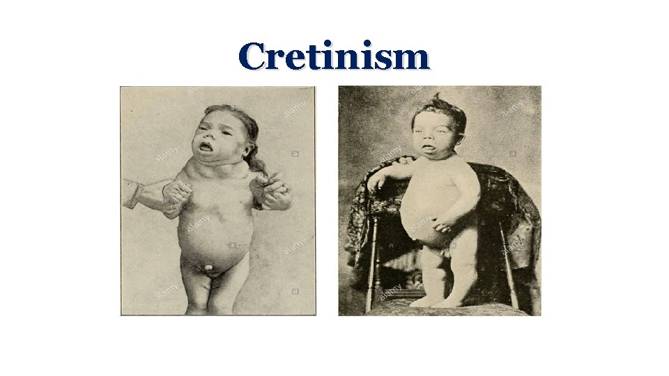 Cretinism 