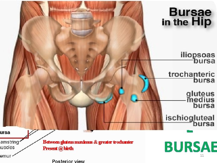 Between gluteus maximus & greater trochanter Present @ birth G L U T E