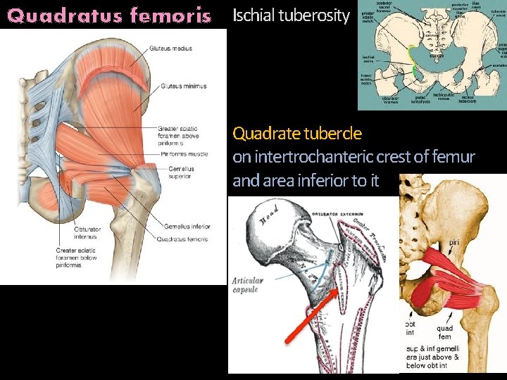 Quadratus femoris Ischial tuberosity Quadrate tubercle on intertrochanteric crest of femur and area inferior