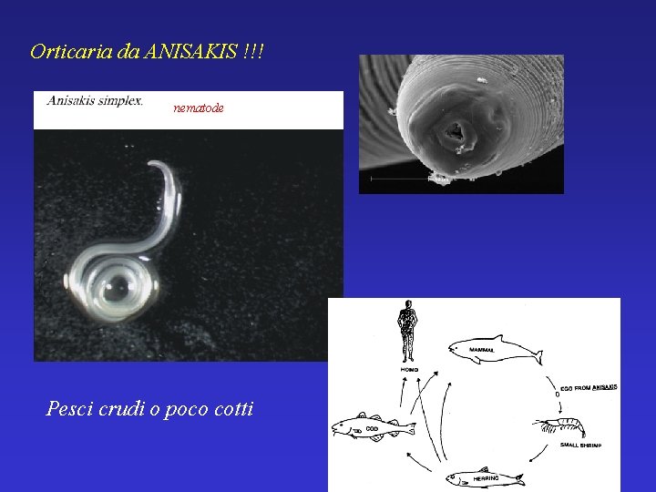 Orticaria da ANISAKIS !!! nematode Pesci crudi o poco cotti 