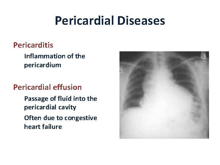 Pericardial Diseases Pericarditis Inflammation of the pericardium Pericardial effusion Passage of fluid into the