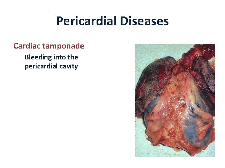 Pericardial Diseases Cardiac tamponade Bleeding into the pericardial cavity 