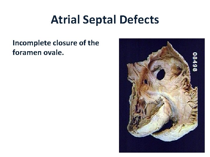 Atrial Septal Defects Incomplete closure of the foramen ovale. 