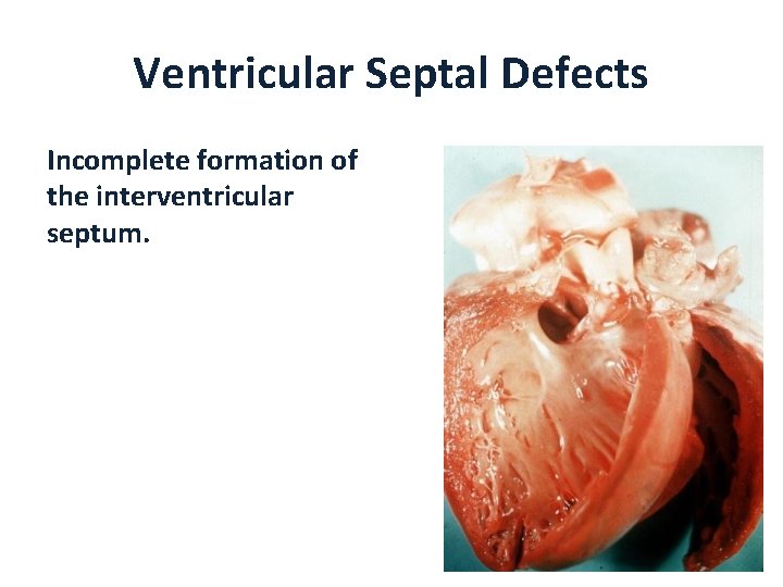 Ventricular Septal Defects Incomplete formation of the interventricular septum. 