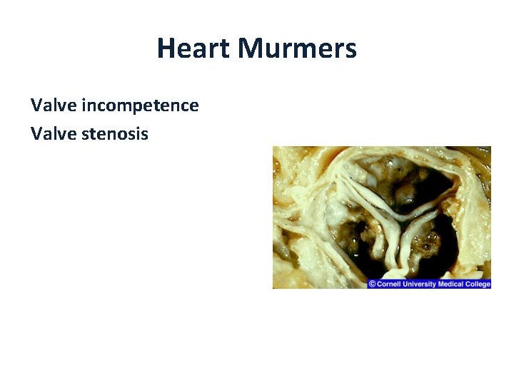 Heart Murmers Valve incompetence Valve stenosis 