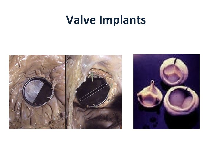Valve Implants 