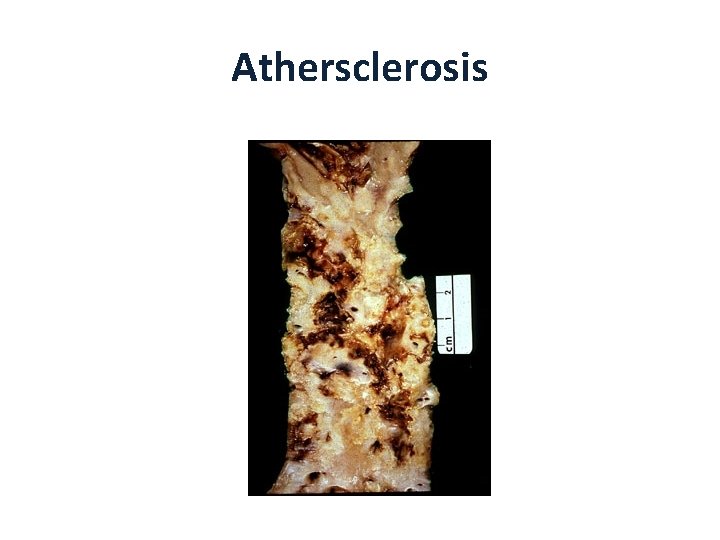 Athersclerosis 