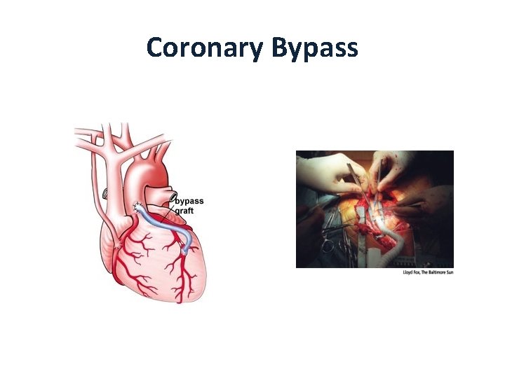 Coronary Bypass 