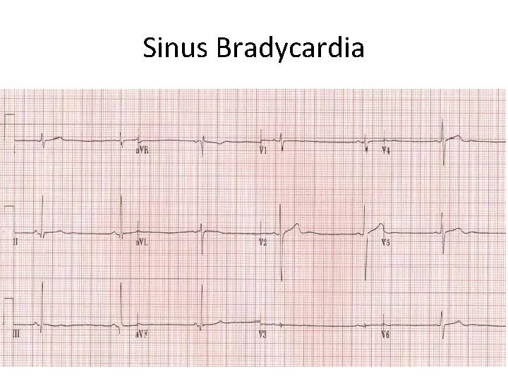 Sinus Bradycardia 