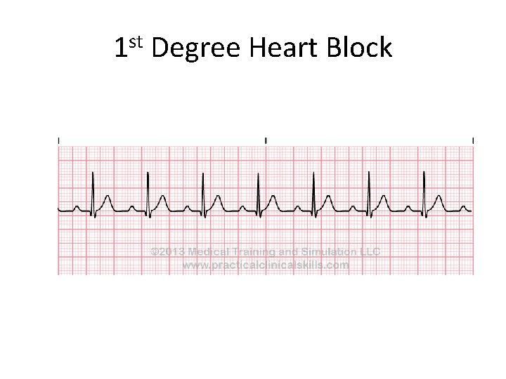1 st Degree Heart Block 