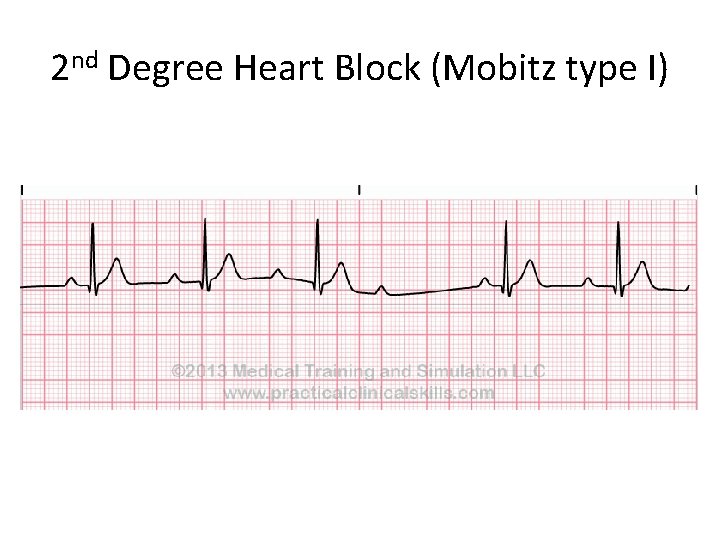 2 nd Degree Heart Block (Mobitz type I) 
