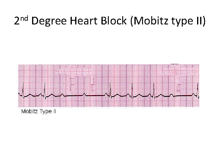 2 nd Degree Heart Block (Mobitz type II) 