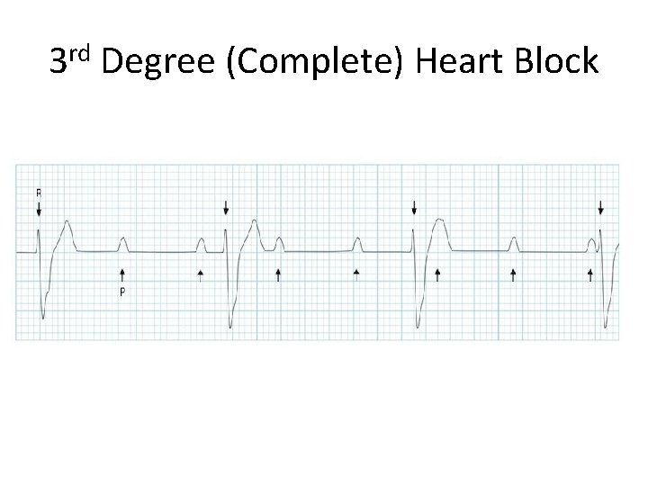 3 rd Degree (Complete) Heart Block 