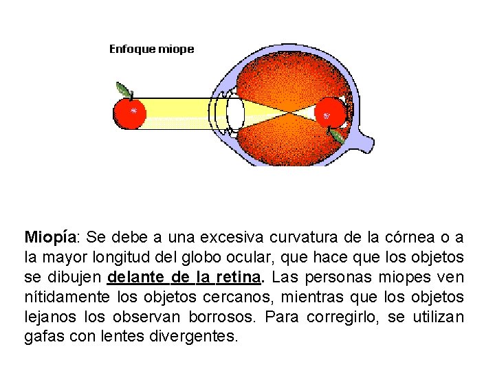 Miopía: Se debe a una excesiva curvatura de la córnea o a la mayor