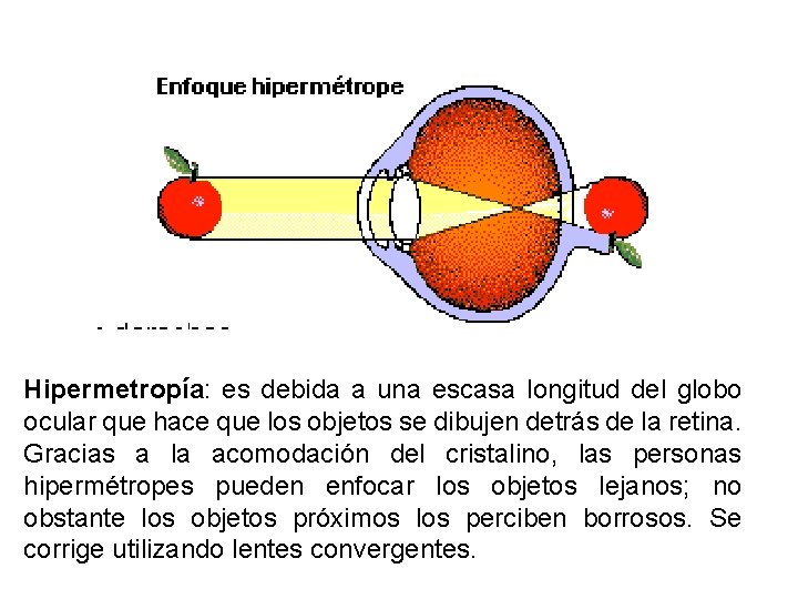 Hipermetropía: es debida a una escasa longitud del globo ocular que hace que los