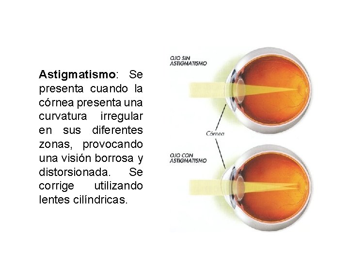 Astigmatismo: Se presenta cuando la córnea presenta una curvatura irregular en sus diferentes zonas,