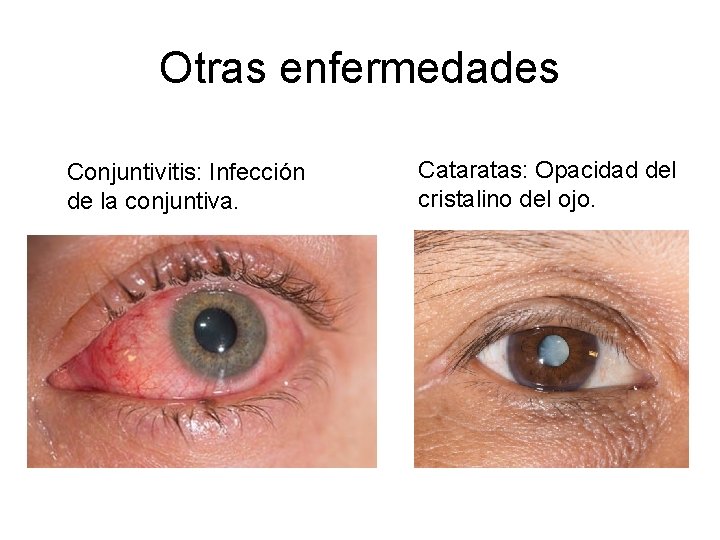 Otras enfermedades Conjuntivitis: Infección de la conjuntiva. Cataratas: Opacidad del cristalino del ojo. 