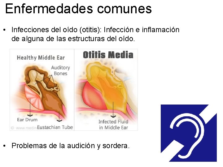 Enfermedades comunes • Infecciones del oído (otitis): Infección e inflamación de alguna de las