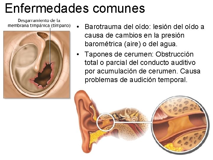 Enfermedades comunes • Barotrauma del oído: lesión del oído a causa de cambios en