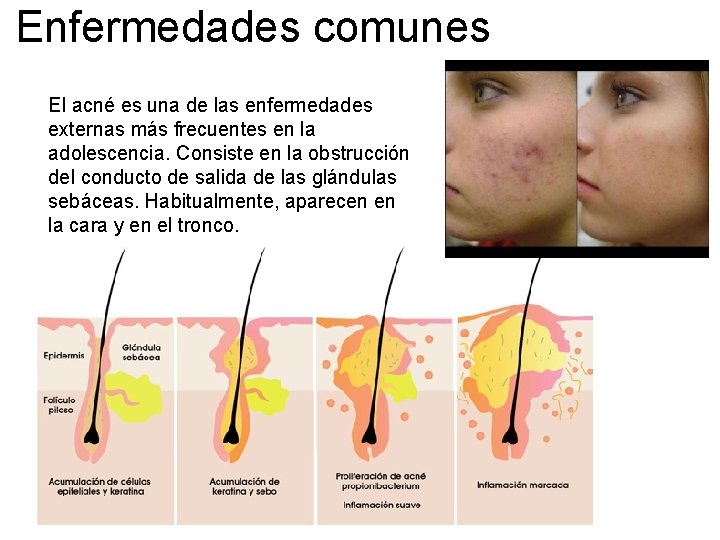 Enfermedades comunes El acné es una de las enfermedades externas más frecuentes en la