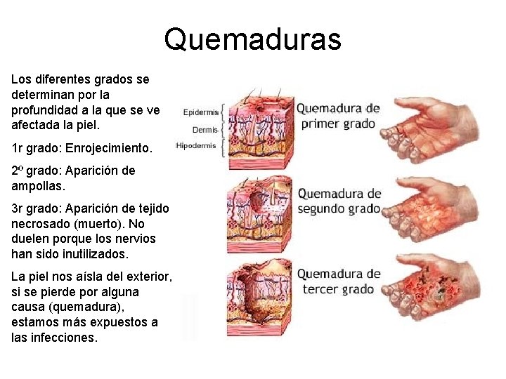 Quemaduras Los diferentes grados se determinan por la profundidad a la que se ve