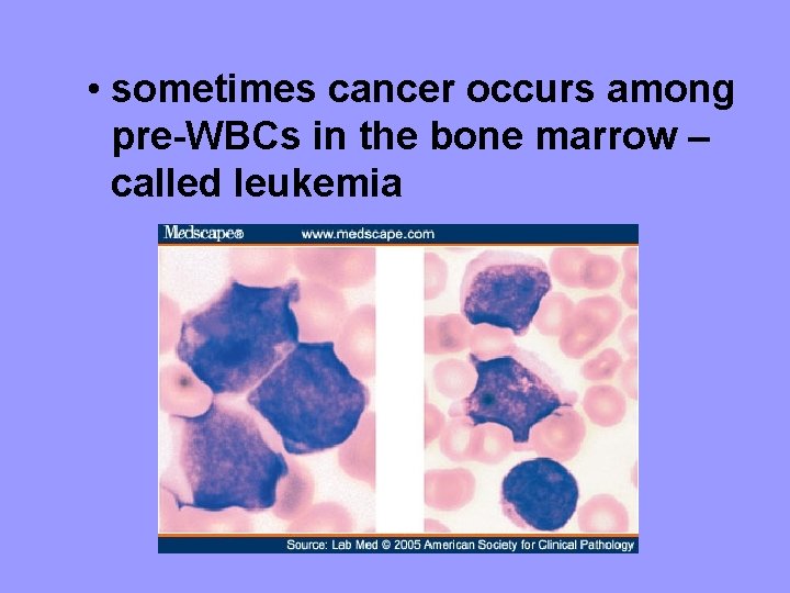  • sometimes cancer occurs among pre-WBCs in the bone marrow – called leukemia