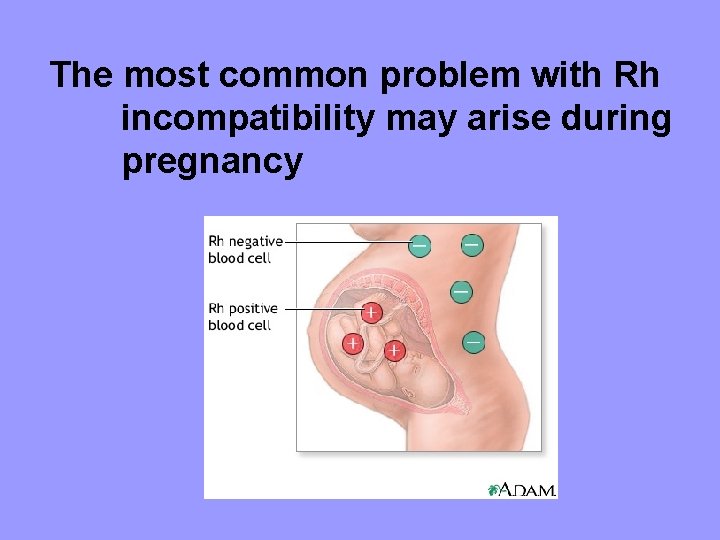 The most common problem with Rh incompatibility may arise during pregnancy 
