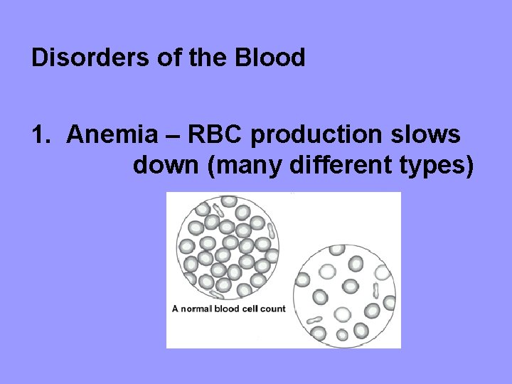 Disorders of the Blood 1. Anemia – RBC production slows down (many different types)